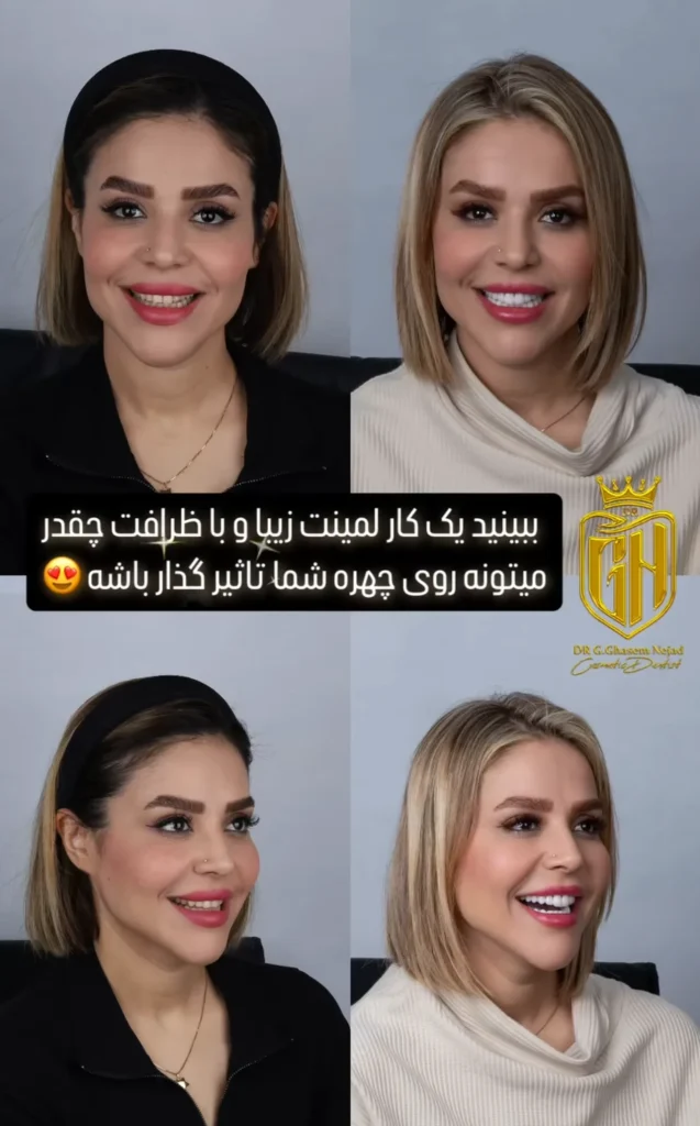 لمینت دندان ویژه vip وی آی پی