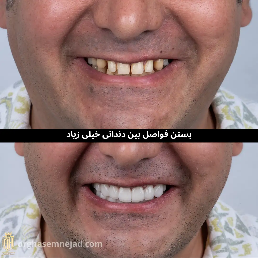 نمونه لمینت دندان و کامپوزیت دندان 2025 (11)