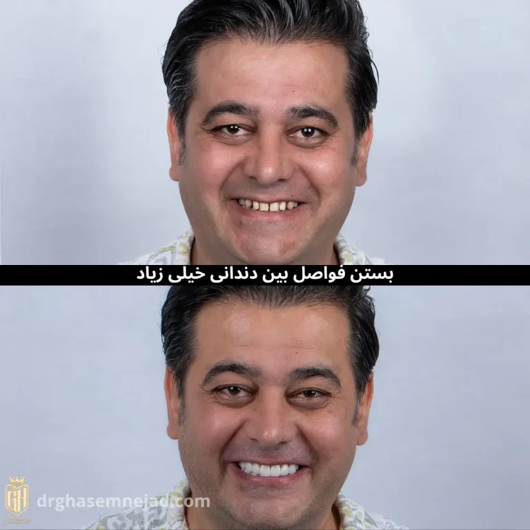 لمینت دندان و کامپوزیت دندان 2025 (12)