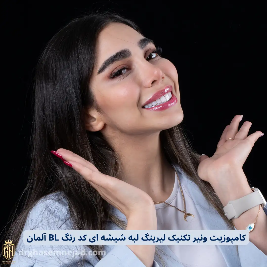 نمونه لمینت دندان و کامپوزیت دندان 2025 (13)