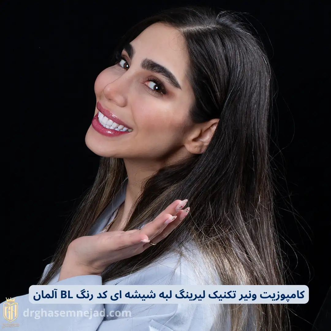 نمونه لمینت دندان و کامپوزیت دندان 2025 (18)