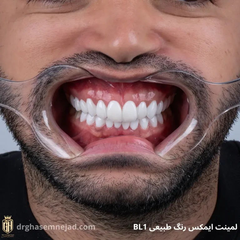 لمینت دندان و کامپوزیت دندان 2025 (3)