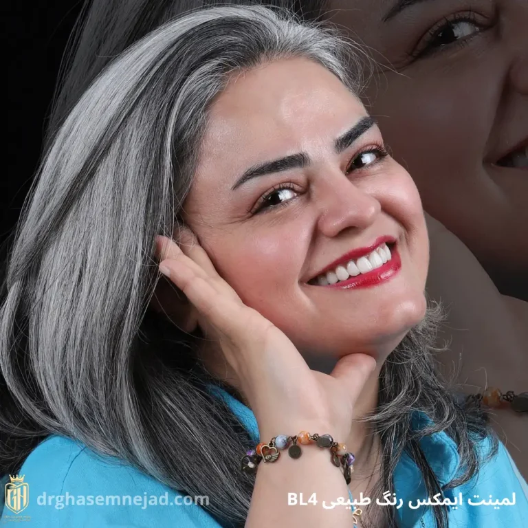 لمینت دندان و کامپوزیت دندان 2025 (7)