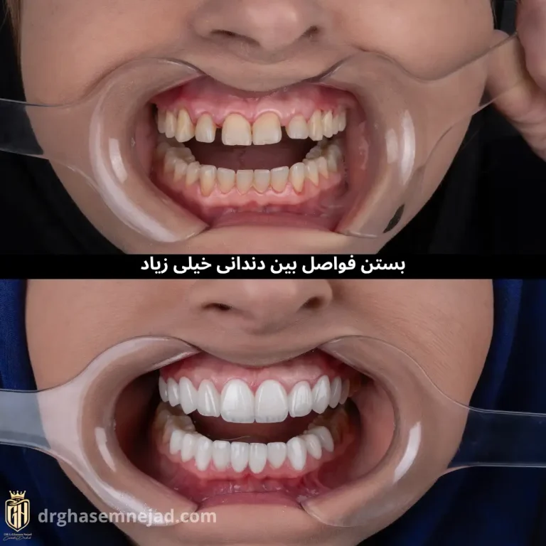 لمینت دندان و کامپوزیت دندان 2025 (8)