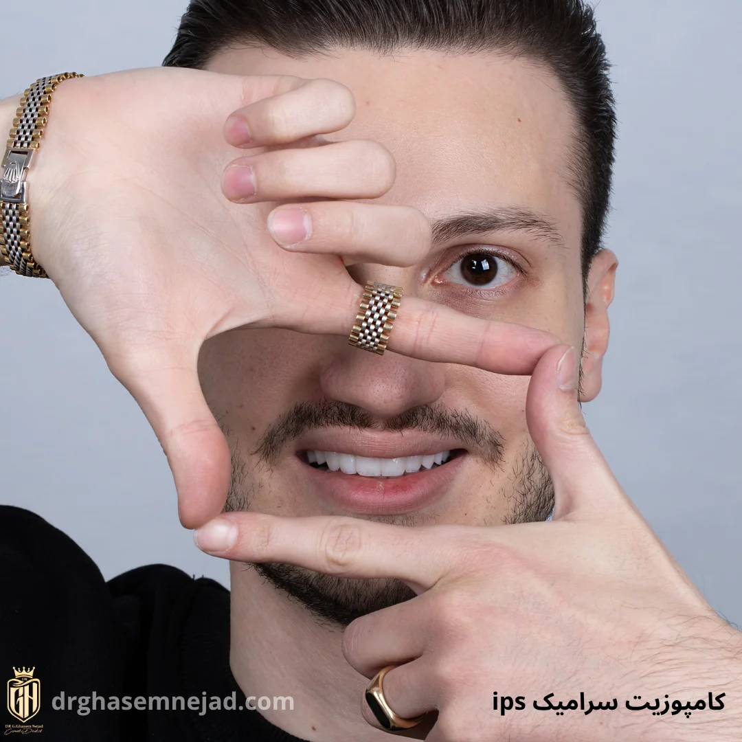 نمونه کامپوزیت آی پی اس ips (1)