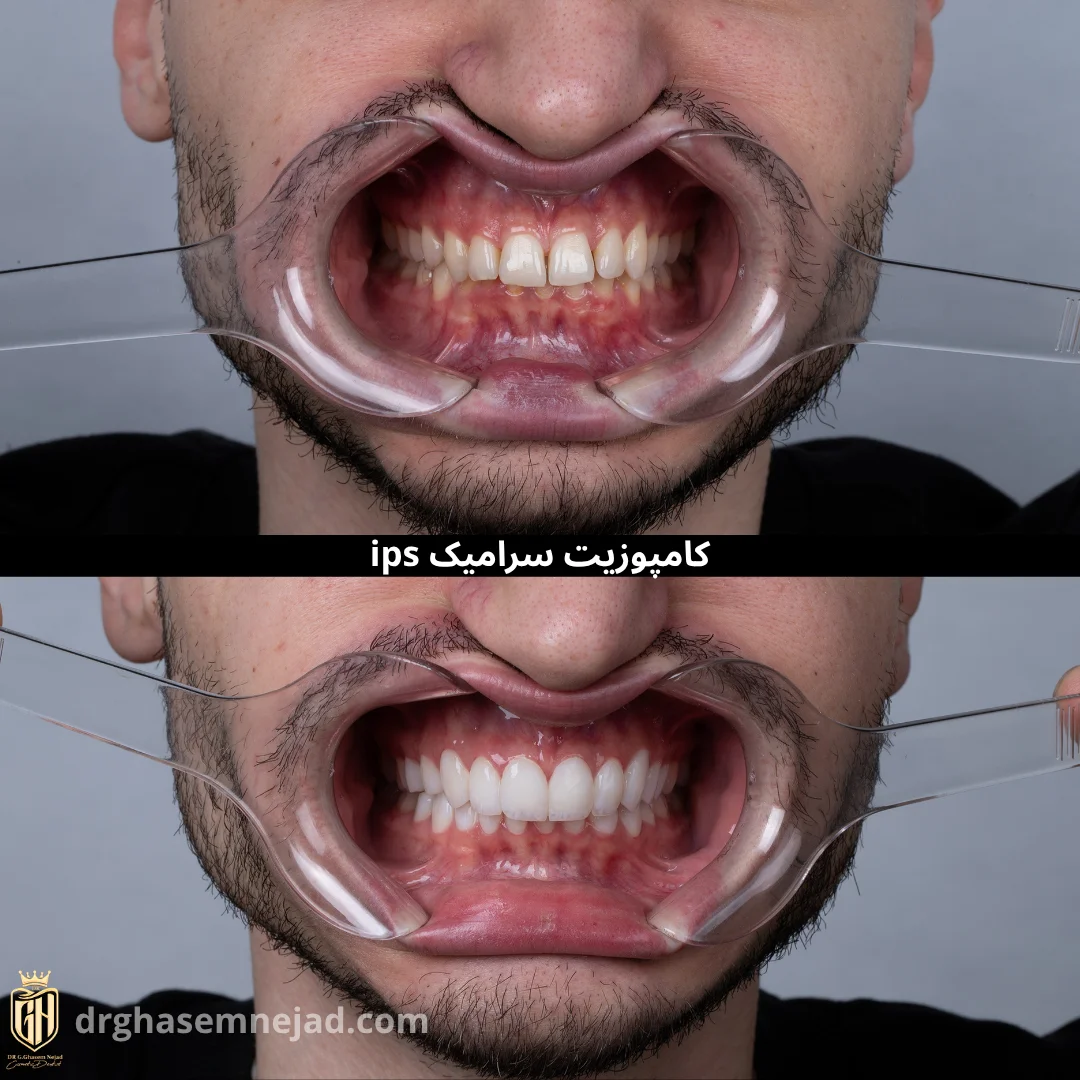 قبل و بعد از کامپوزیت دندان