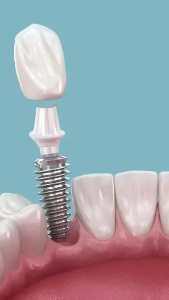 ایمپلنت دندان فوری