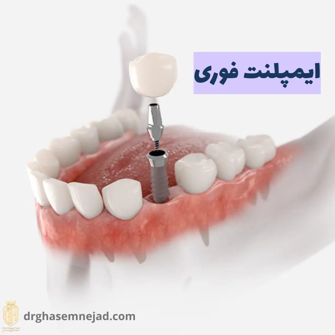 ایمپلنت فوری