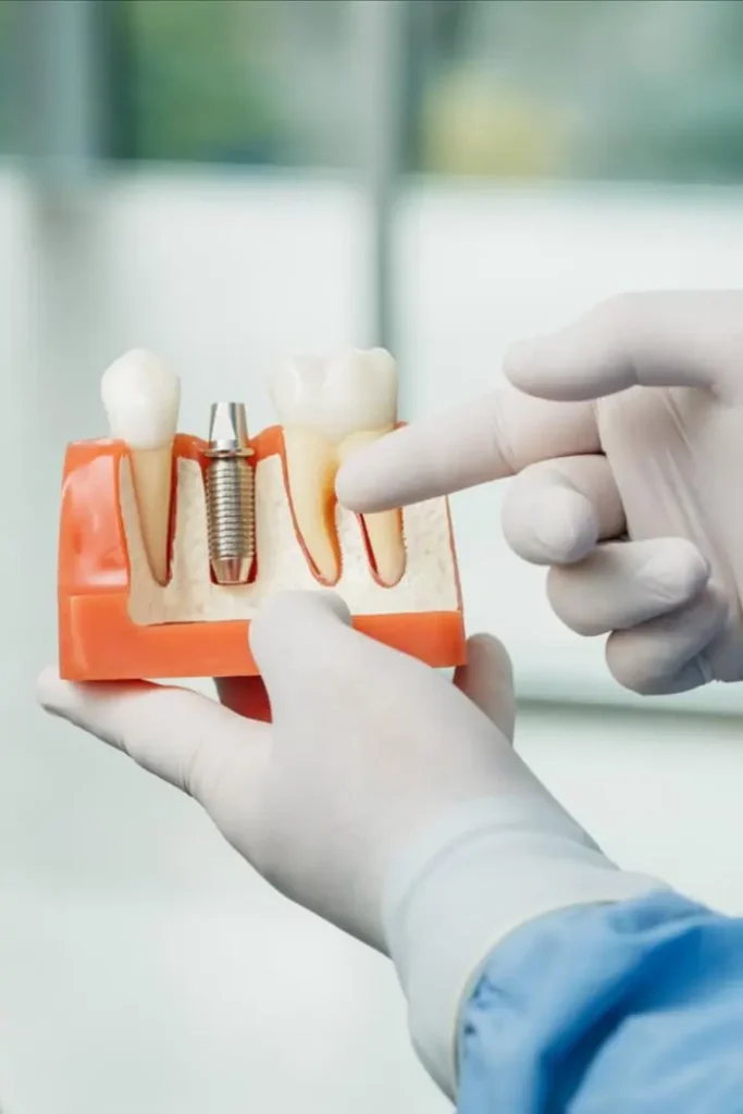 ایمپلنت یک روزه