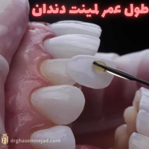 طول عمر لمینت دندان