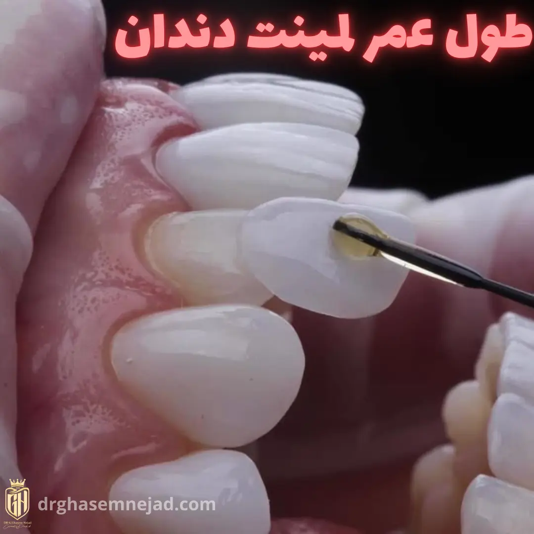 طول عمر لمینت دندان