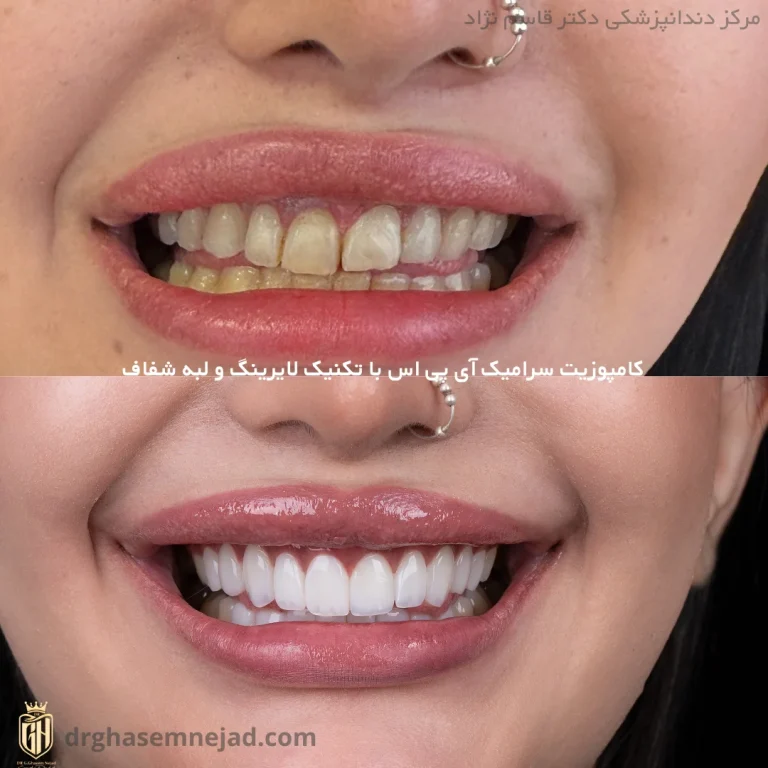  قبل و بعد کامپوزیت دندان
