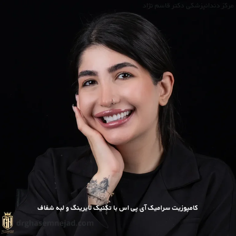  کامپوزیت دندان ips (1)