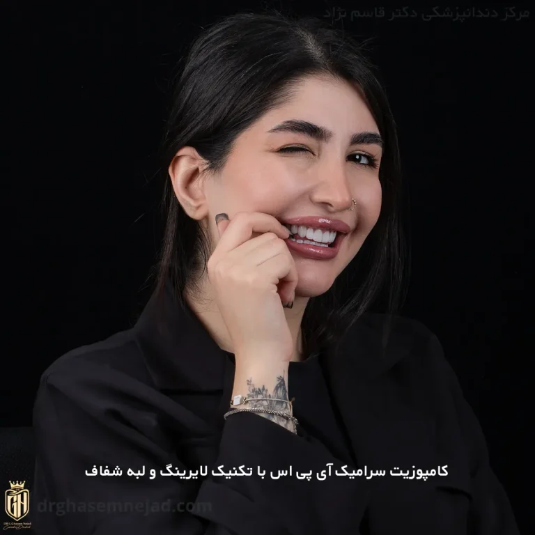  کامپوزیت دندان ips (2)