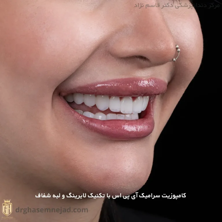  کامپوزیت دندان ips (3)