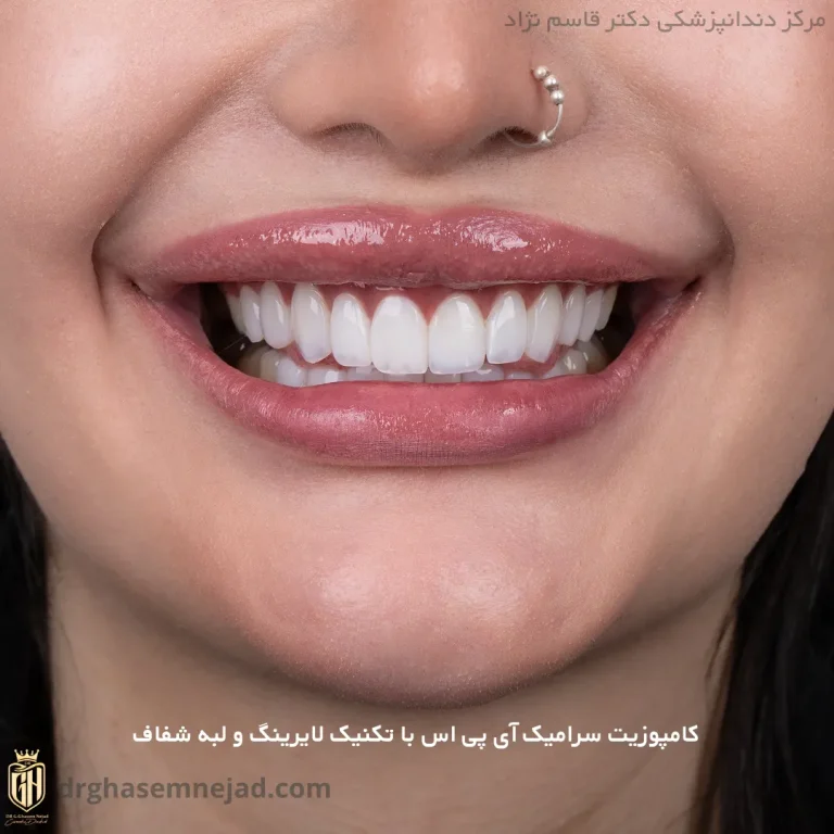  کامپوزیت دندان ips (4)