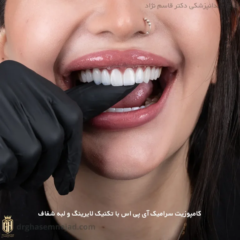  کامپوزیت دندان ips (5)