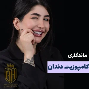 ماندگاری کامپوزیت دندان